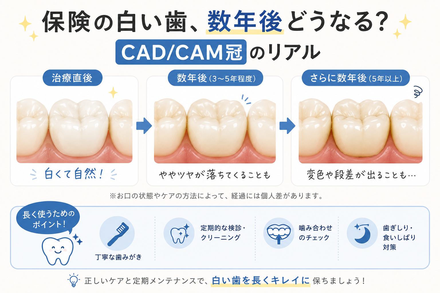 「CAD/CAM冠って取れやすいんですか？」