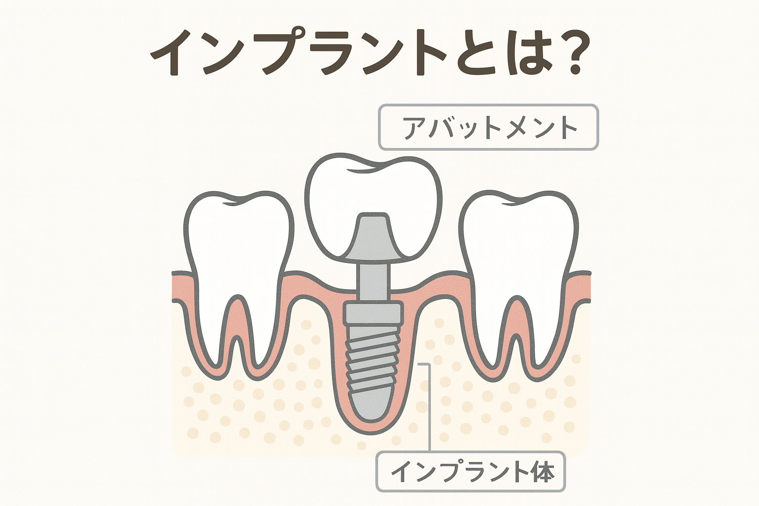 インプラントとは